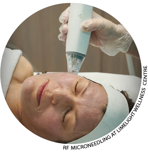 RF Needling in Vancouver at Limelight Wellness Centre