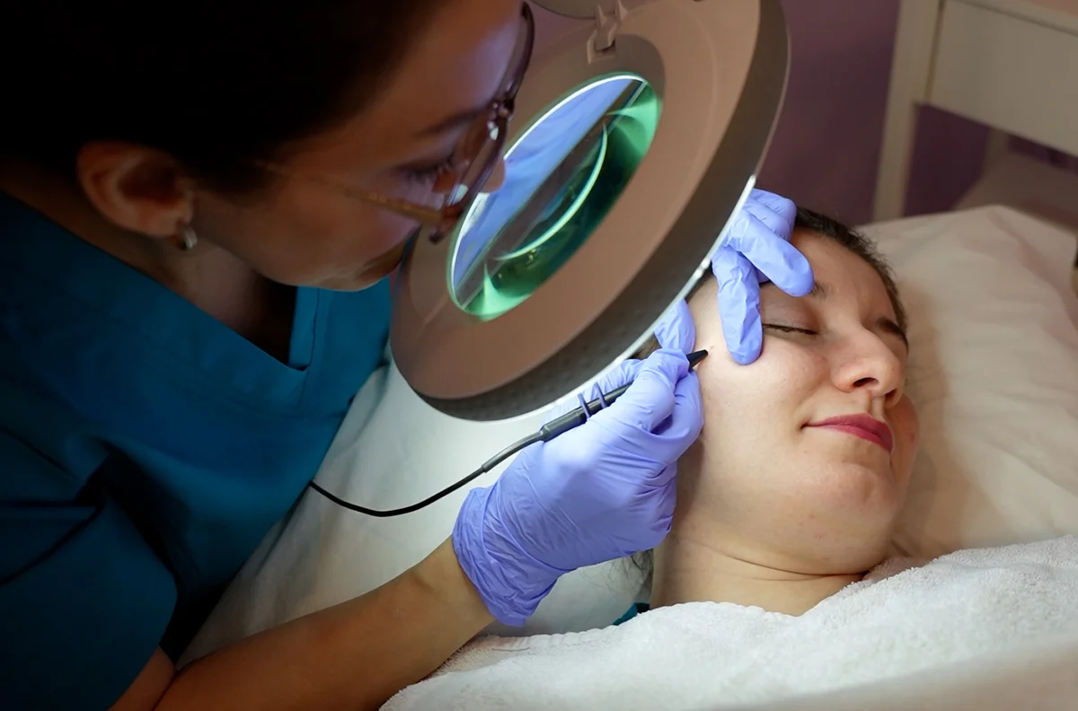 Laser assisted pigmentation treatment