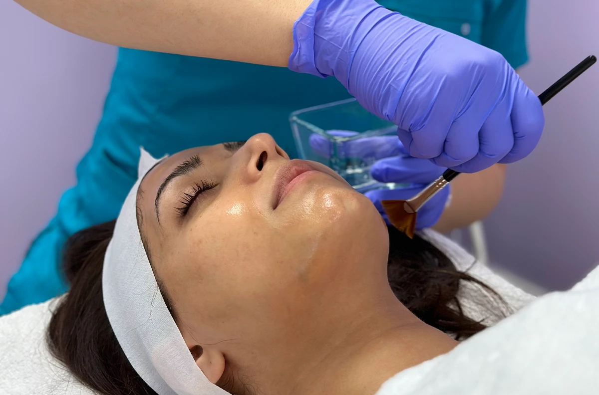 Dermal Peeling