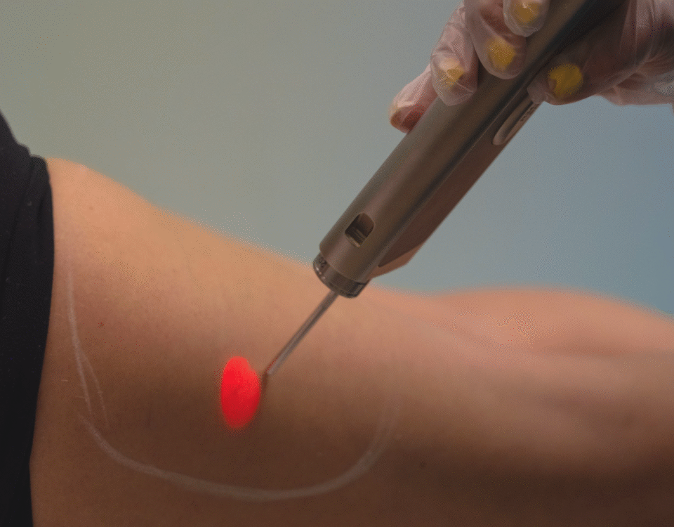 Laser Skin Tightening: The Non-Invasive Anti-Aging Solution