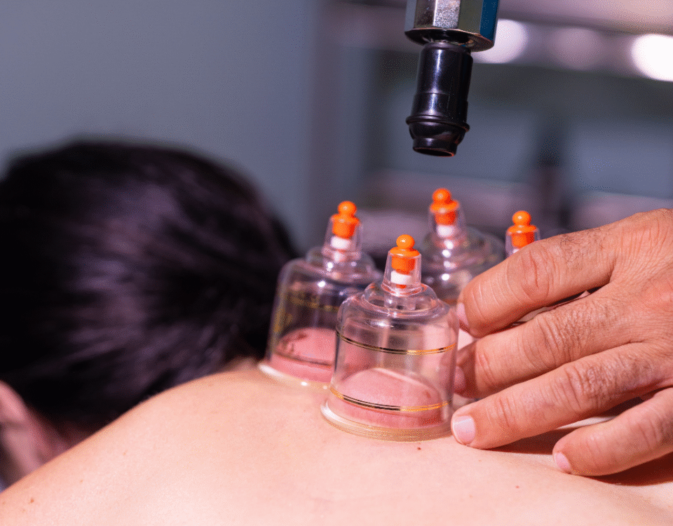 Cupping Therapy Explained: Benefits for Wellness in Vancouver Clinics