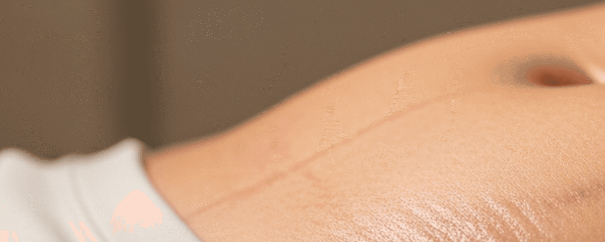 What Happens to Skin After Weight Loss: Expert Insights & Care