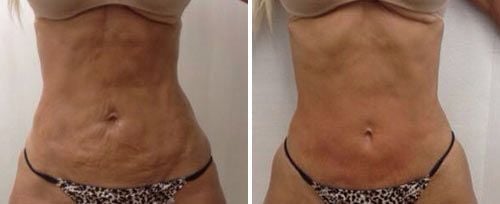 Body Contouring