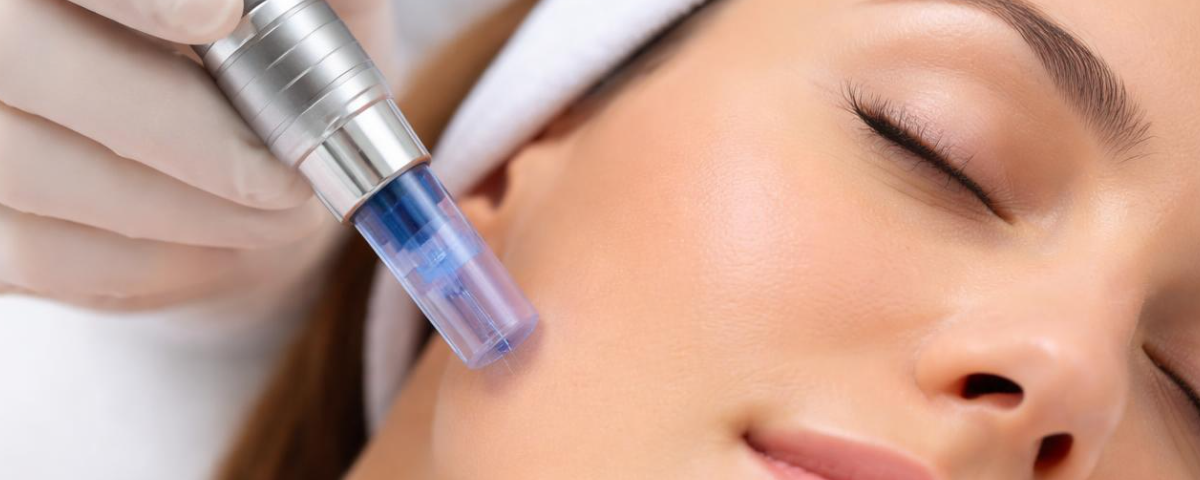 Microneedling for Healthy Skin: What It Is, How It Works, and What to Expect