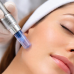 Microneedling for Healthy Skin: What It Is, How It Works, and What to Expect